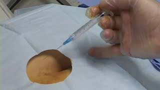 Caudal  Nerve Block Image