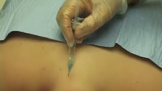Cervical Epidural Nerve Block Image