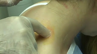 Trigger Point Block Image