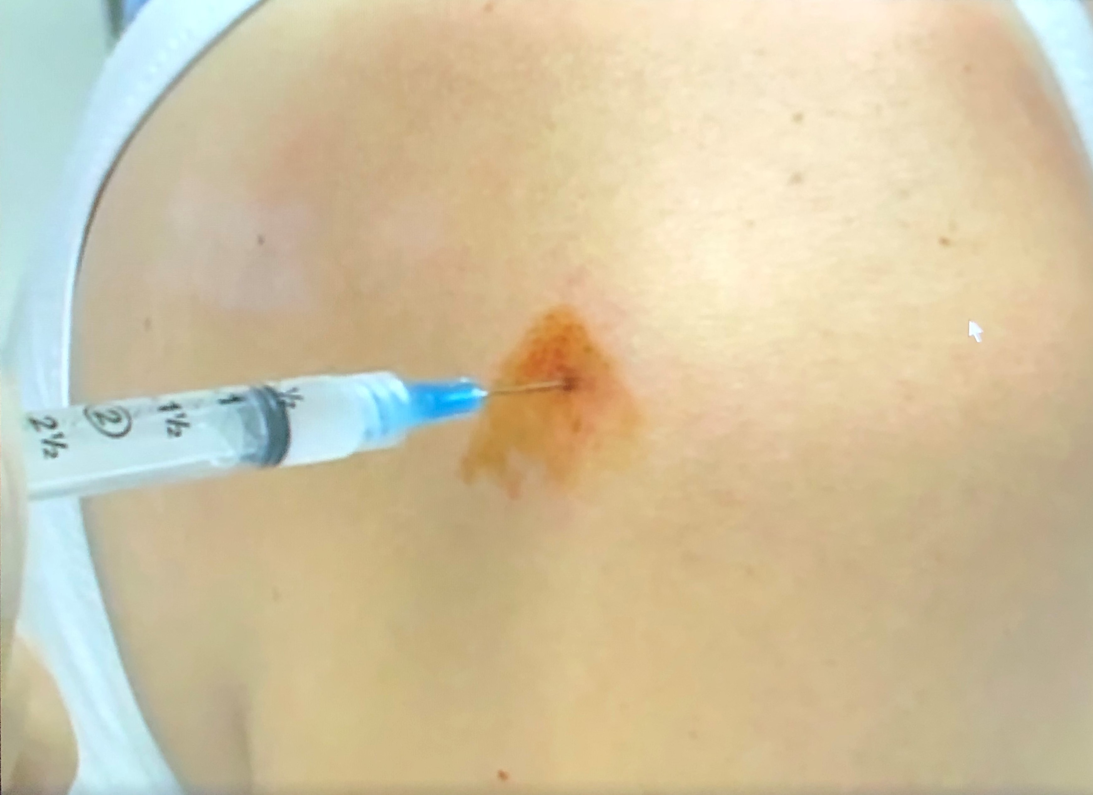 Trigger Point and Brachial Plexus Nerve Blocks