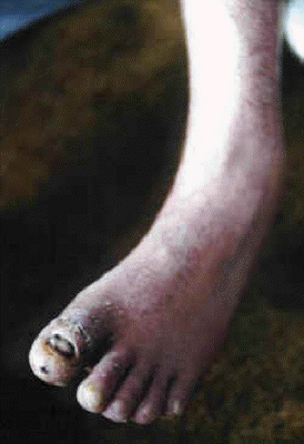 db_Left_Foot_Deformity_Pic_-3_copy1 (1)
