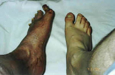 db_Left_Foot_Deformity_Pic_-6_copy1