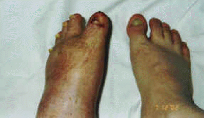 db_Left_Foot_Deformity_Pic_-7_copy1
