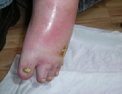 db_RSD_Infection_Pic_-4_copy1