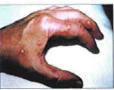 db_Skin_Lesions_from_VP_Injury_copy1