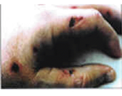 db_Ulcers_from_VP_Injury_copy1