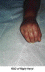 Hand Deformity Picture #1 