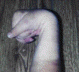 Hand Deformity Picture #4 