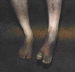 Left Foot Deformity Picture #4 