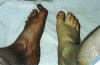 Left Foot Deformity Picture #6 