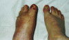 Left Foot Deformity Picture #7 