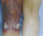 Skin ulcers after treatment.
