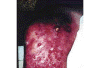 Skin ulcers caused from application of ice.