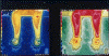 Thermography of Electircal Injury Patient.